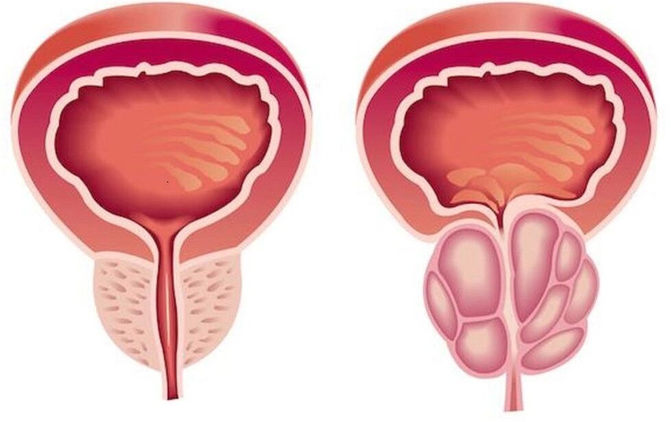 egészséges és gyulladt prosztata prosztatagyulladással