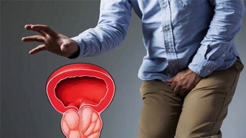 a prosztatagyulladás tünetei egy férfiban